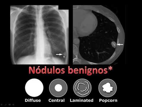 Entendendo a Calcificação do Pulmão: Causas e Implicações