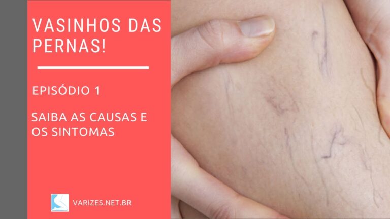 Principais causas de vasinhos nas pernas