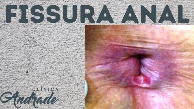 Cirurgia de Fissura Retal: O Guia Completo