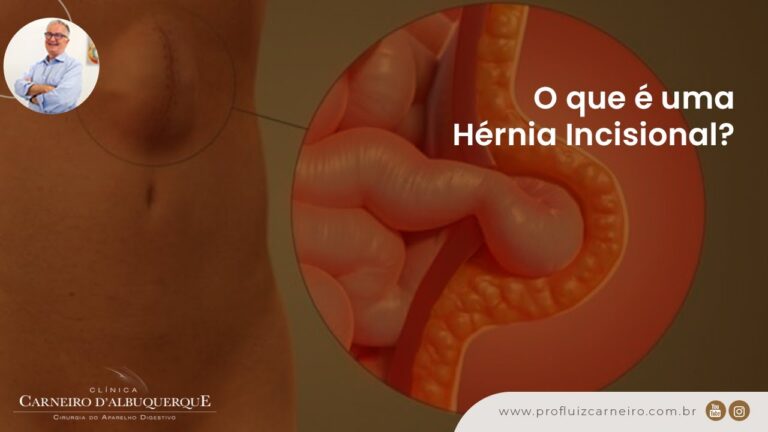 A gravidade da hérnia incisional: o que você precisa saber