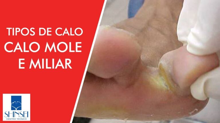 Descubra os Segredos dos Calos Moles