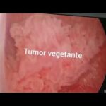 Aorta Ateromatosa: Significado e Implicações