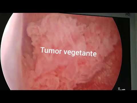 Lesão Vegetante na Bexiga: O que Você Precisa Saber
