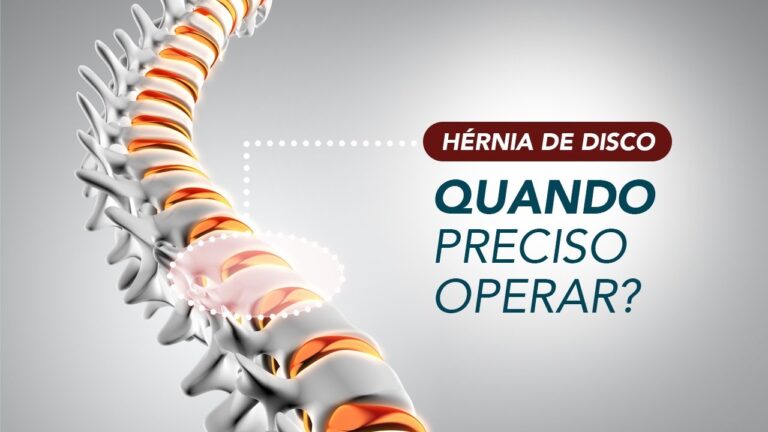 Necessidade de Cirurgia para Hérnia Extrusa: Uma Revisão Atualizada