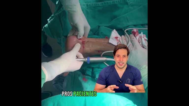 Cirurgia para tratamento do espor&atilde;o de calc&acirc;neo: uma abordagem otimizada