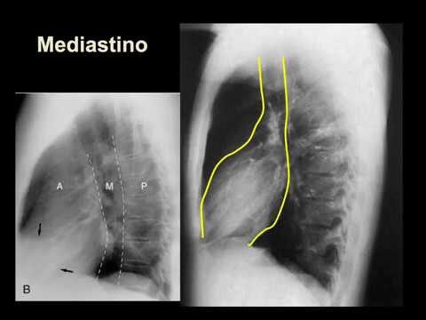 Gravidade do Tumor no Mediastino