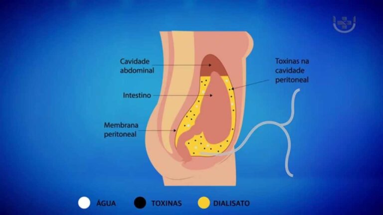 Cateter de Diálise Peritoneal: Tudo o que Você Precisa Saber