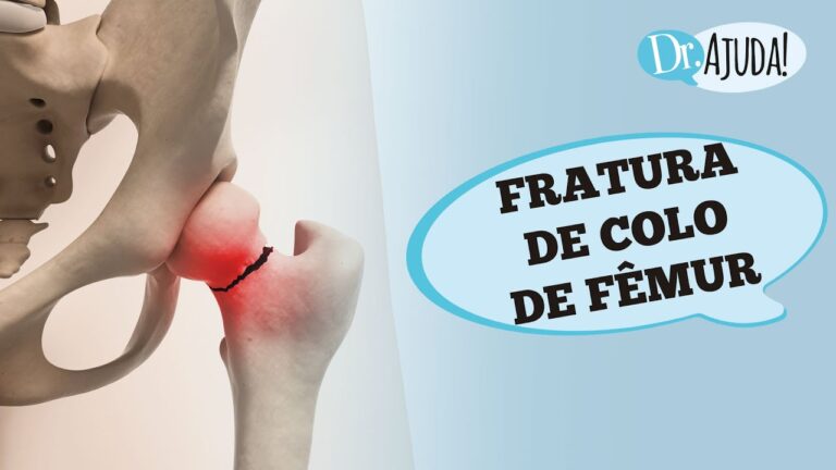 Fratura de F&ecirc;mur: Causas, Sintomas e Tratamentos