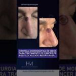 Nevo Azul Maligno: O que você precisa saber