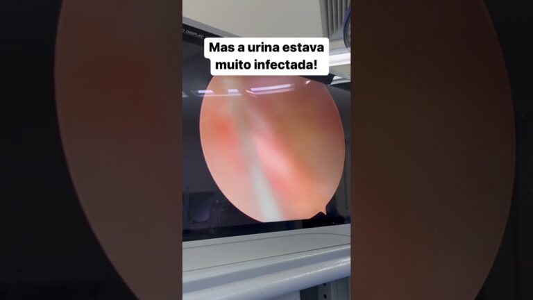 Pus na urina: sintomas, causas e tratamentos