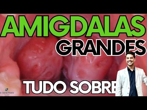 Hipertrofia de Amígdalas Grau 3: Diagnóstico e Tratamento