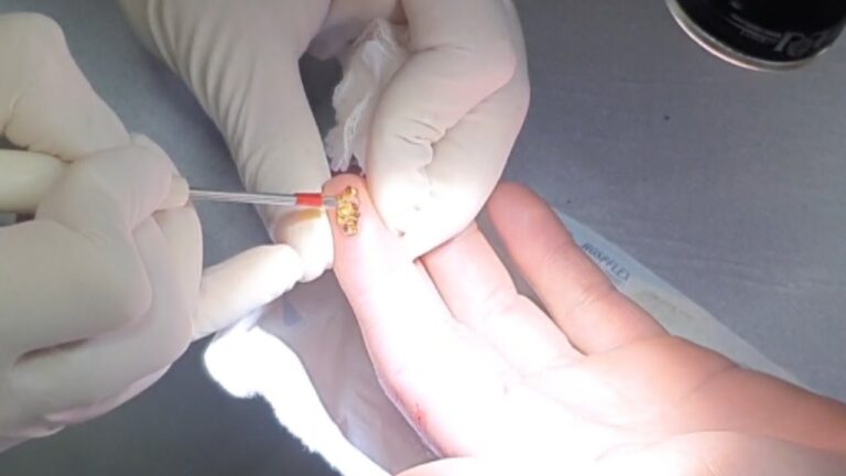 Cirurgia de Verruga: Tudo o que você precisa saber