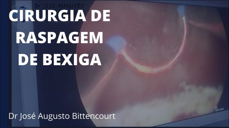 Raspagem da Bexiga: O que voc&ecirc; precisa saber