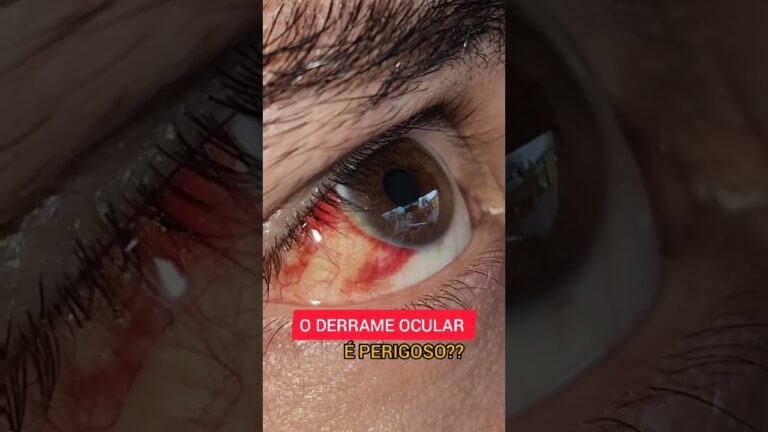 Os Perigos do Derrame Ocular