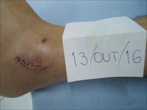 Guia Completo: Cirurgia de Ligamento do Tornozelo