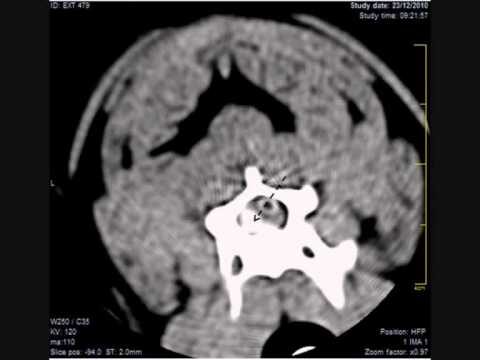 Compressão cervical C5 C6: Causas, Sintomas e Tratamento
