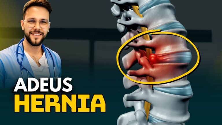 Rela&ccedil;&atilde;o entre hernia de disco e compress&atilde;o do nervo ci&aacute;tico