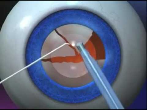 Entenda a técnica da facoemulsificação
