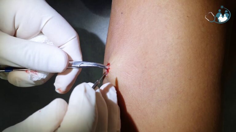 Exérese de Lesão: Remoção Eficiente de Tumores de Pele e Mucosas