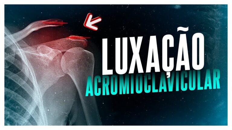 Luxação acromioclavicular grau 3: Tempo de recuperação otimizado