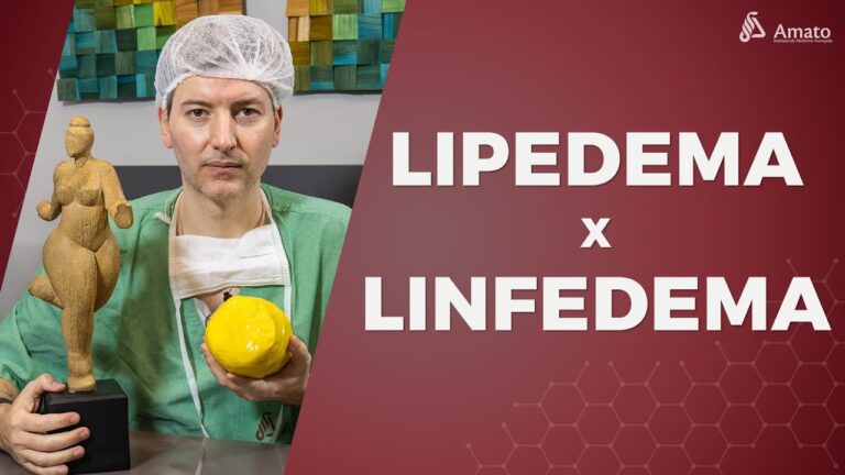 Diferenças entre lipedema e linfedema: Guia Completo