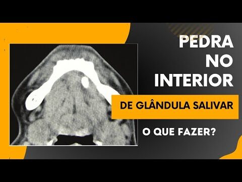 Como tratar pedra na glândula salivar: guia completo