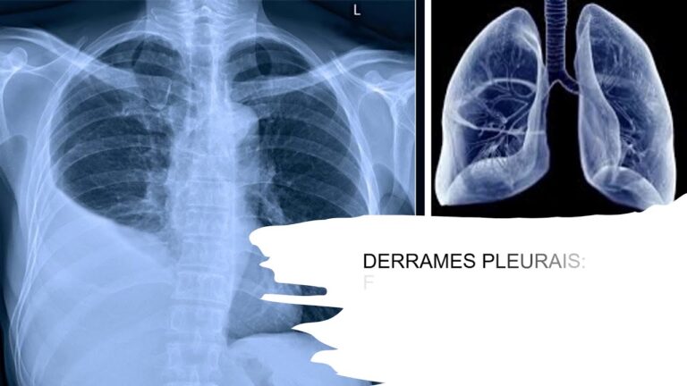 Cuidados de Enfermagem no Derrame Pleural: Guia Prático