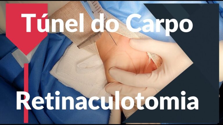 Cirurgia de Síndrome do Túnel do Carpo: Opções e Recuperação