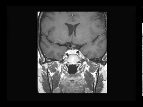Diagn&oacute;stico preciso de aneurisma cerebral atrav&eacute;s de resson&acirc;ncia magn&eacute;tica