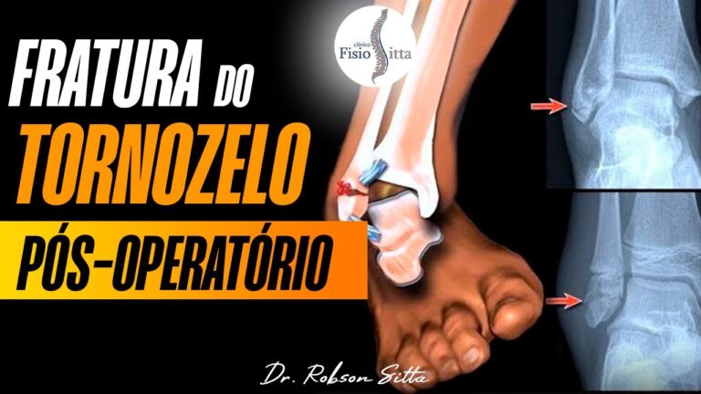 Tempo de recupera&ccedil;&atilde;o de fratura no mal&eacute;olo: O que esperar