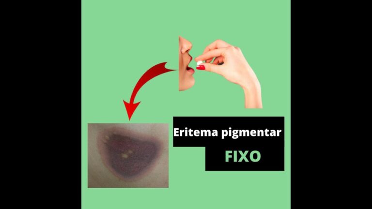 Fotos do eritema pigmentar fixo: uma visão otimizada