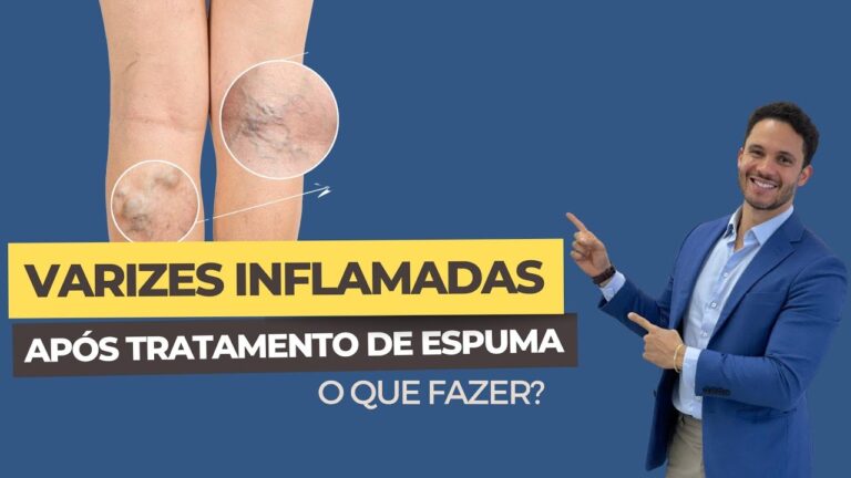 Tratamentos eficazes para varizes inflamadas