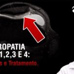 Fotos de HPV em Homens: O que Voc&ecirc; Precisa Saber