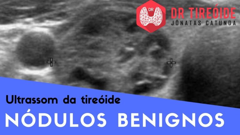 Nódulo Isogênico na Tireoide: O Que Você Precisa Saber