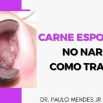 Como tratar a casquinha preta no bico do seio: Guia completo