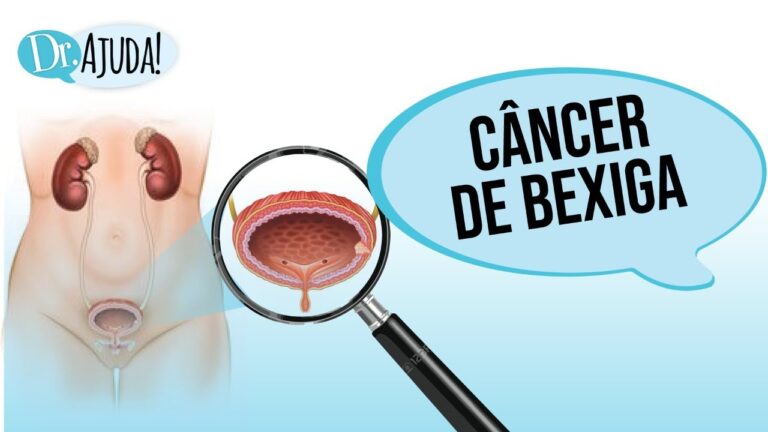 Sintomas do câncer de bexiga em fase terminal