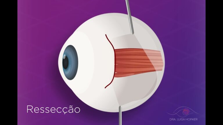 Transformação: Cirurgia de Estrabismo Antes e Depois