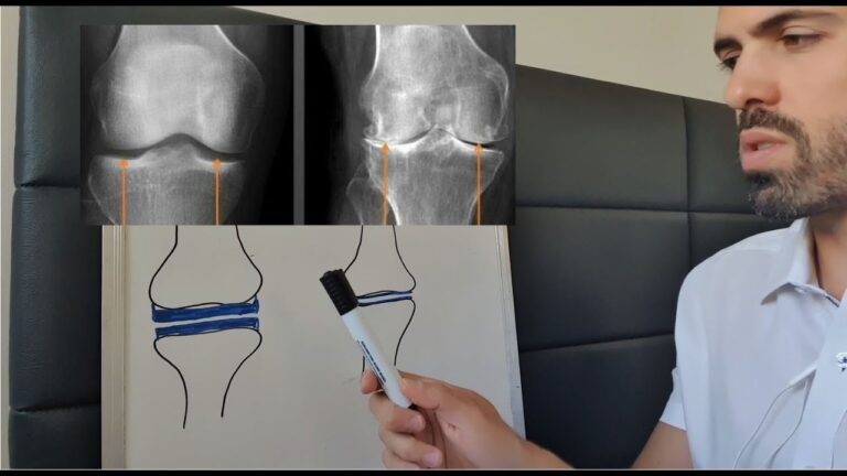 Sintomas de Osteófitos no Joelho: O Que Você Deve Saber