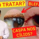 Artrose no Bra&ccedil;o: Causas, Sintomas e Tratamentos