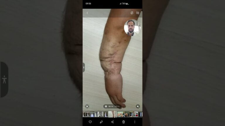 Tratamento e recuperação de fratura de antebraço: Guia completo