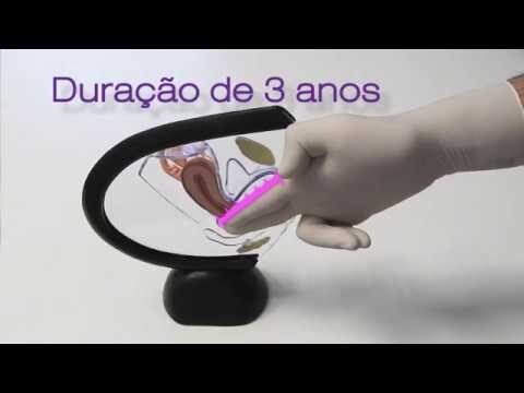 Guia para Comprar Diafragma Contraceptivo: Tudo o que Precisa Saber