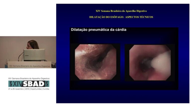 Dilatação Esofágica: Causas, Sintomas e Tratamentos