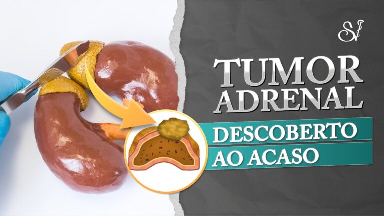 O perigo do feocromocitoma: diagnóstico e tratamento