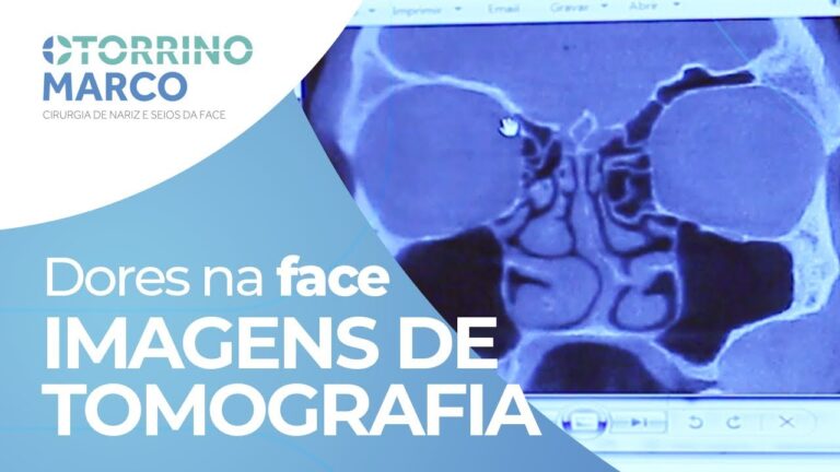 Tomografia para diagnóstico de desvio de septo: uma análise otimizada