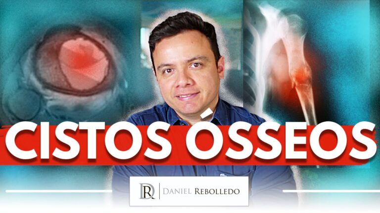 Cisto ósseo grave: causas, sintomas e tratamento