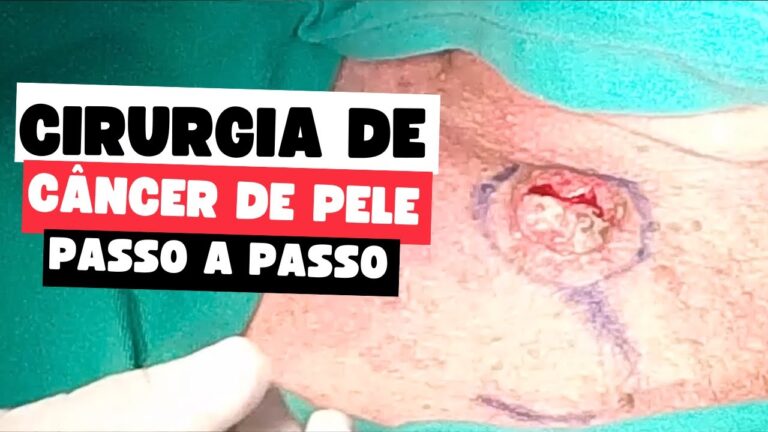 Recuperação cirurgia câncer de pele: o que esperar