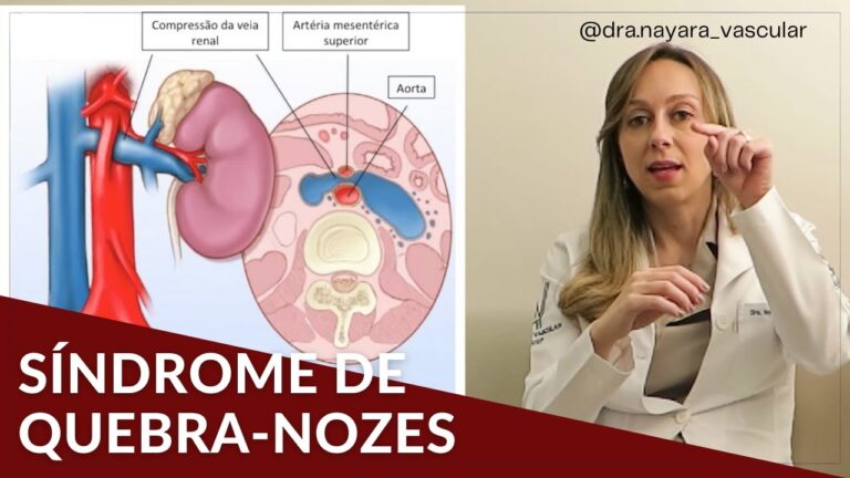 Entendendo a Gravidade do Síndrome Quebra-Nozes