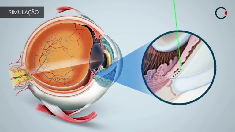 Cirurgia de Glaucoma a Laser: Preço e Benefícios