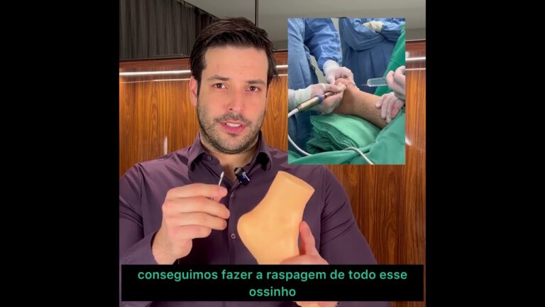 Cirurgia para Espor&atilde;o do Calc&acirc;neo: Guia Completo