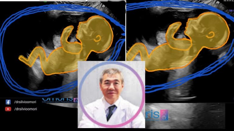 Ultrassom de g&ecirc;meos monozig&oacute;ticos compartilhando placenta: o que esperar
